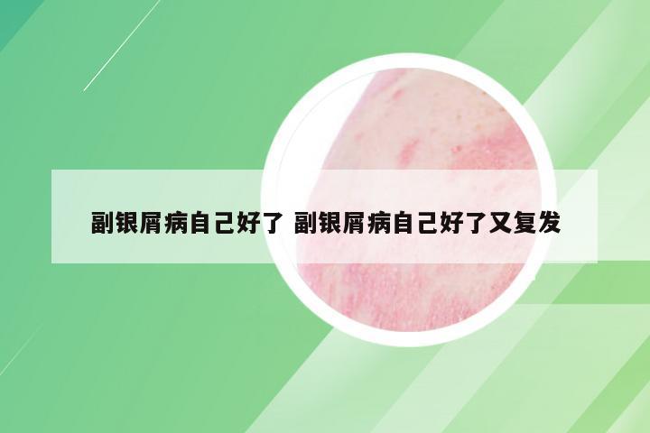 副银屑病自己好了 副银屑病自己好了又复发