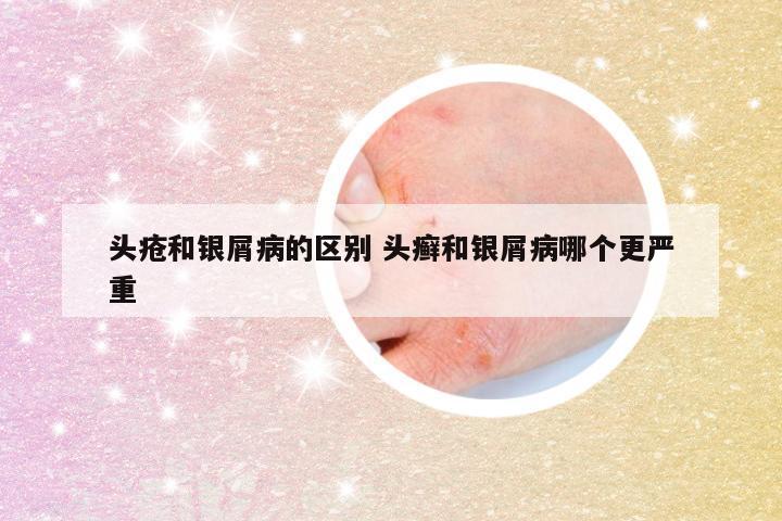 头疮和银屑病的区别 头癣和银屑病哪个更严重