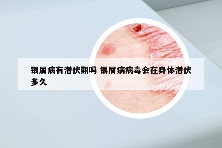 银屑病有潜伏期吗 银屑病病毒会在身体潜伏多久