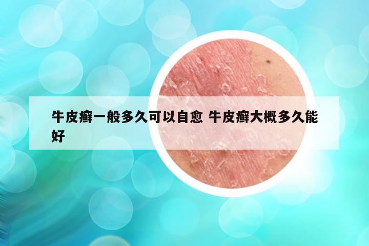牛皮癣一般多久可以自愈 牛皮癣大概多久能好
