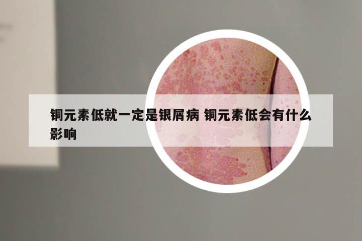 铜元素低就一定是银屑病 铜元素低会有什么影响