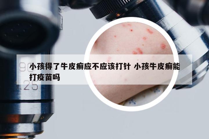 小孩得了牛皮癣应不应该打针 小孩牛皮癣能打疫苗吗