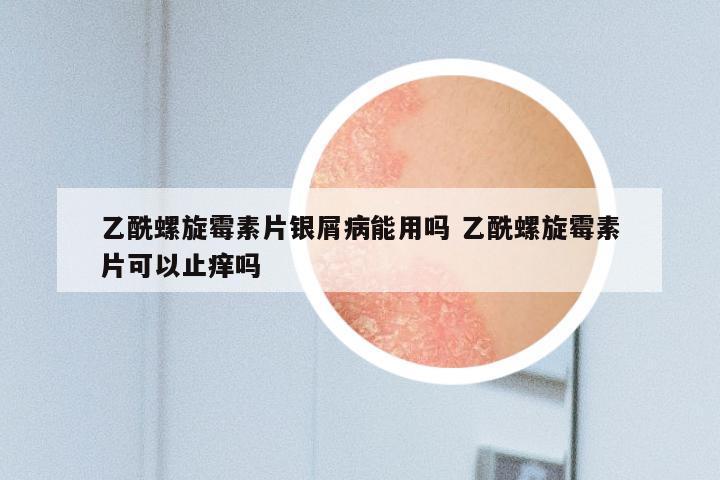 乙酰螺旋霉素片银屑病能用吗 乙酰螺旋霉素片可以止痒吗