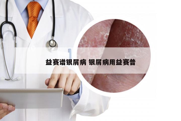 益赛谱银屑病 银屑病用益赛普