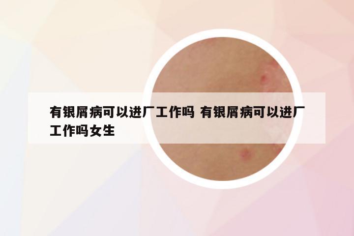 有银屑病可以进厂工作吗 有银屑病可以进厂工作吗女生