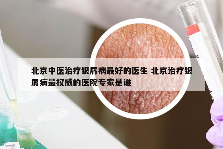 北京中医治疗银屑病最好的医生 北京治疗银屑病最权威的医院专家是谁