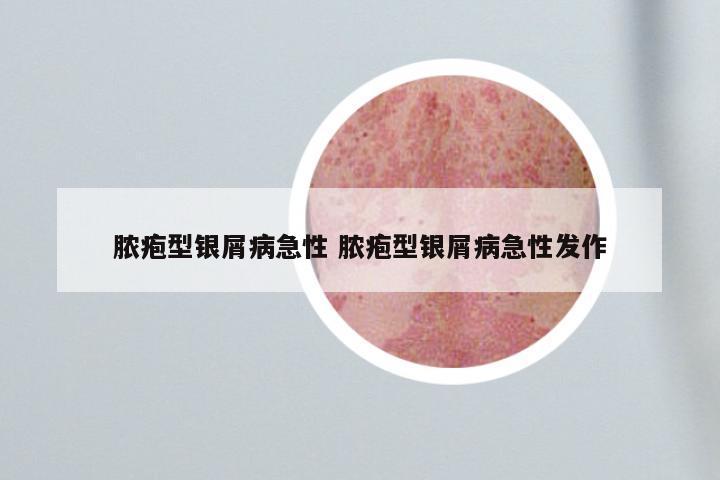 脓疱型银屑病急性 脓疱型银屑病急性发作