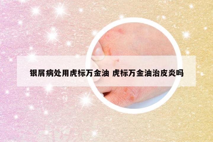 银屑病处用虎标万金油 虎标万金油治皮炎吗