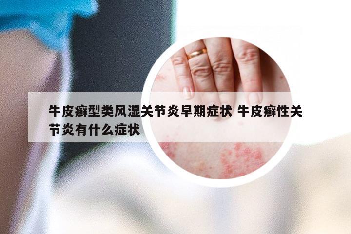 牛皮癣型类风湿关节炎早期症状 牛皮癣性关节炎有什么症状