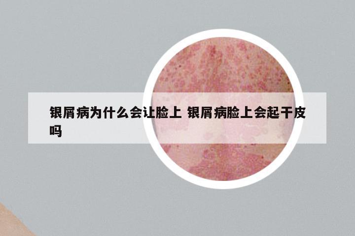 银屑病为什么会让脸上 银屑病脸上会起干皮吗