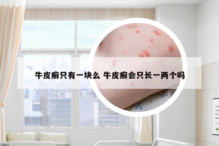 牛皮癣只有一块么 牛皮癣会只长一两个吗