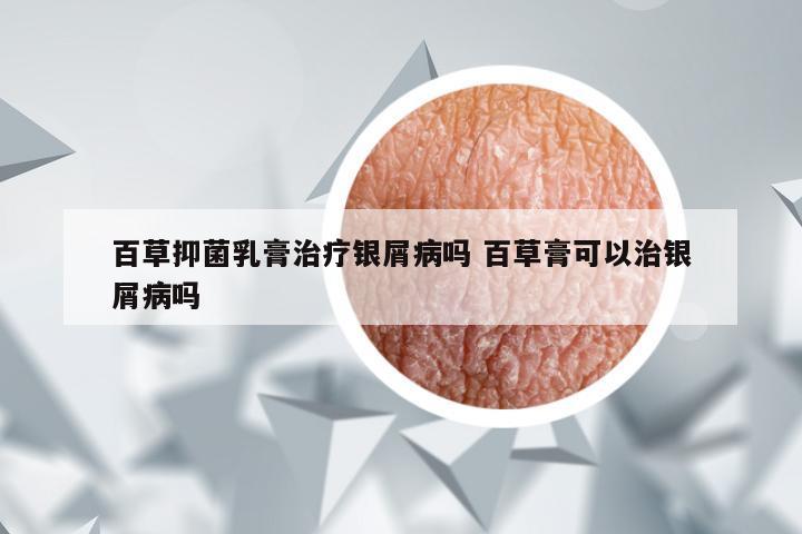 百草抑菌乳膏治疗银屑病吗 百草膏可以治银屑病吗