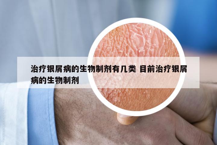 治疗银屑病的生物制剂有几类 目前治疗银屑病的生物制剂