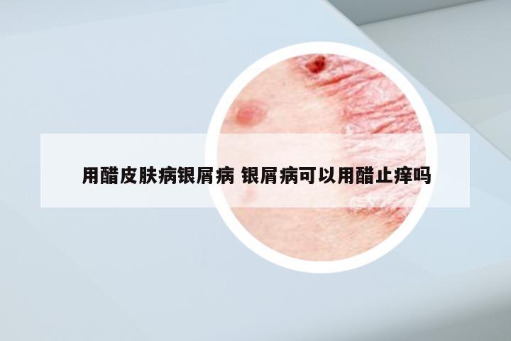 用醋皮肤病银屑病 银屑病可以用醋止痒吗