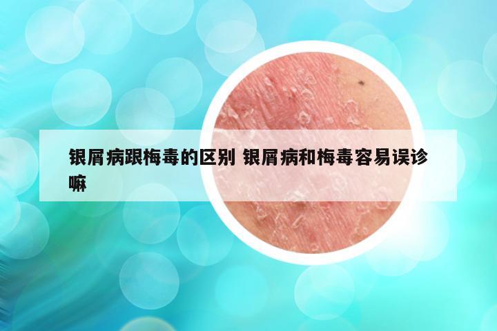 银屑病跟梅毒的区别 银屑病和梅毒容易误诊嘛