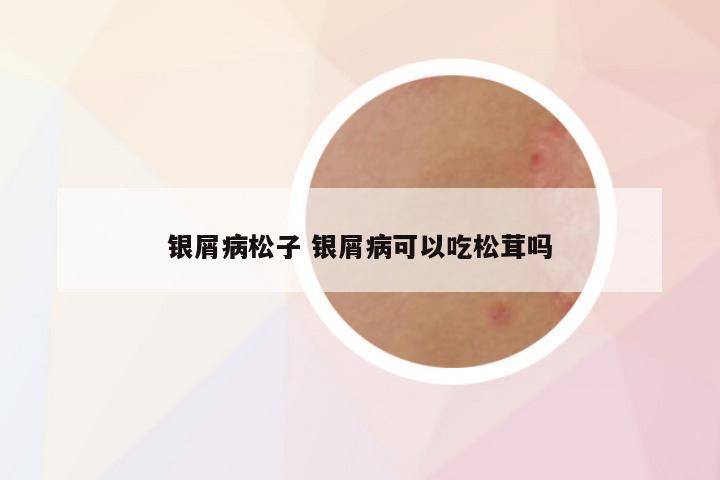 银屑病松子 银屑病可以吃松茸吗