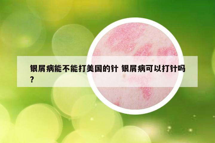 银屑病能不能打美国的针 银屑病可以打针吗?
