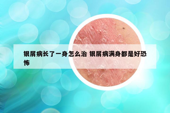 银屑病长了一身怎么治 银屑病满身都是好恐怖