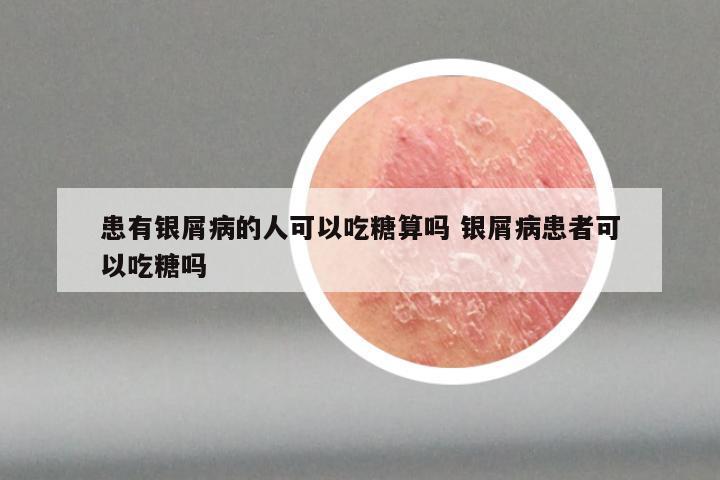 患有银屑病的人可以吃糖算吗 银屑病患者可以吃糖吗