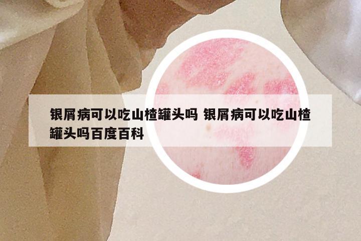 银屑病可以吃山楂罐头吗 银屑病可以吃山楂罐头吗百度百科