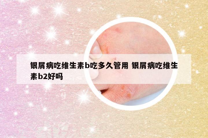 银屑病吃维生素b吃多久管用 银屑病吃维生素b2好吗