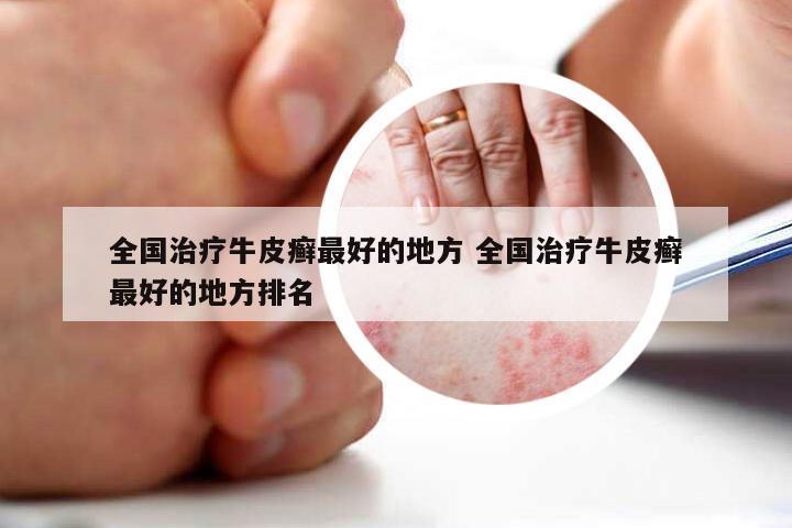 全国治疗牛皮癣最好的地方 全国治疗牛皮癣最好的地方排名