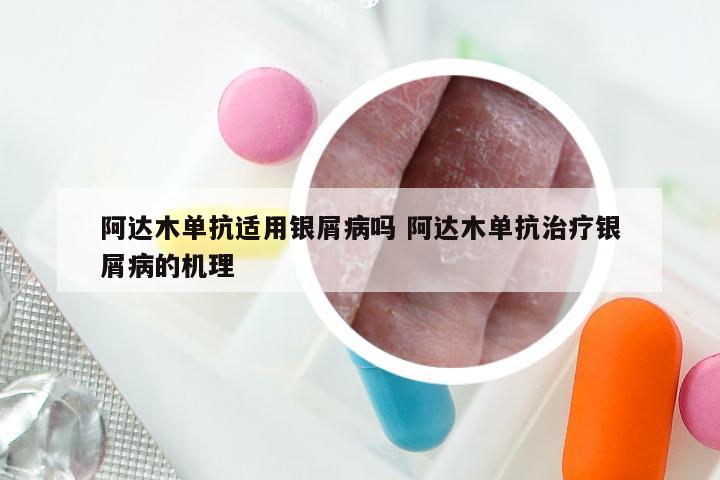 阿达木单抗适用银屑病吗 阿达木单抗治疗银屑病的机理