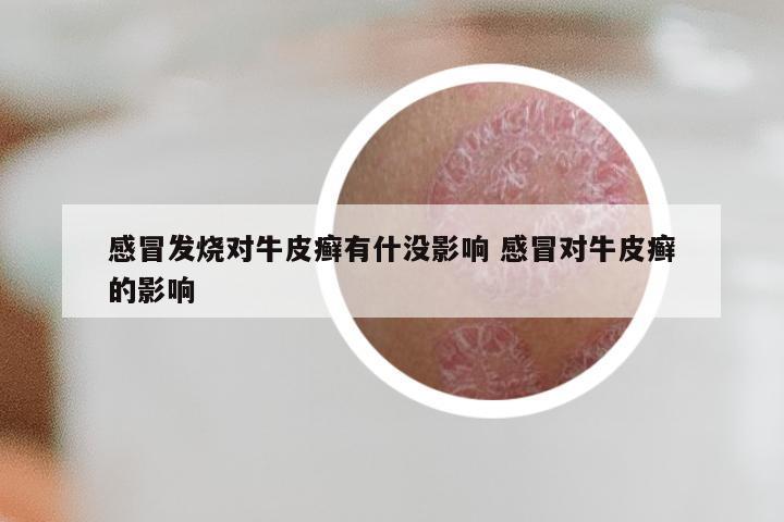 感冒发烧对牛皮癣有什没影响 感冒对牛皮癣的影响