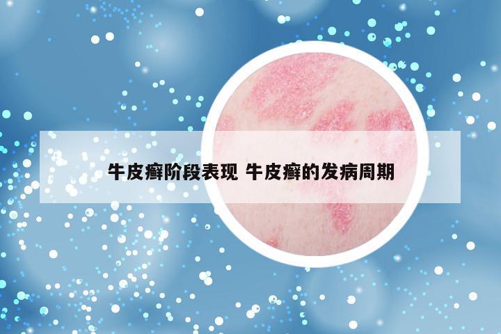 牛皮癣阶段表现 牛皮癣的发病周期