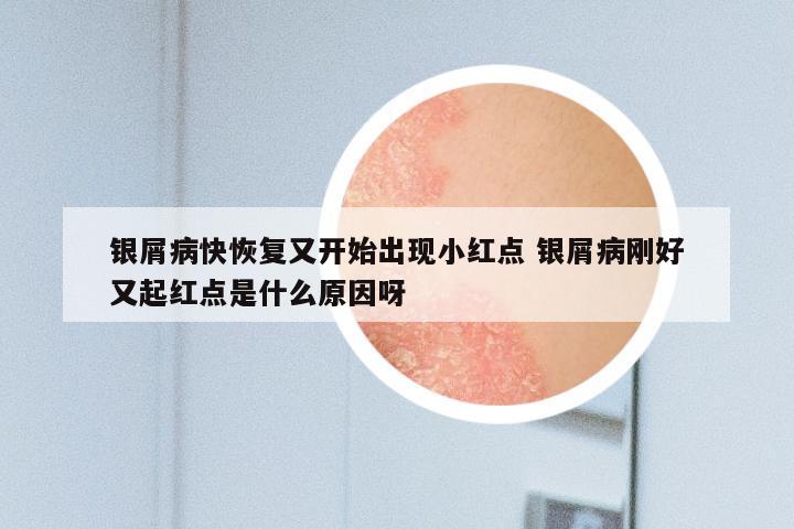银屑病快恢复又开始出现小红点 银屑病刚好又起红点是什么原因呀