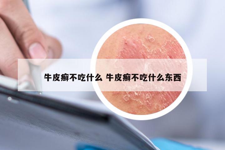 牛皮癣不吃什么 牛皮癣不吃什么东西