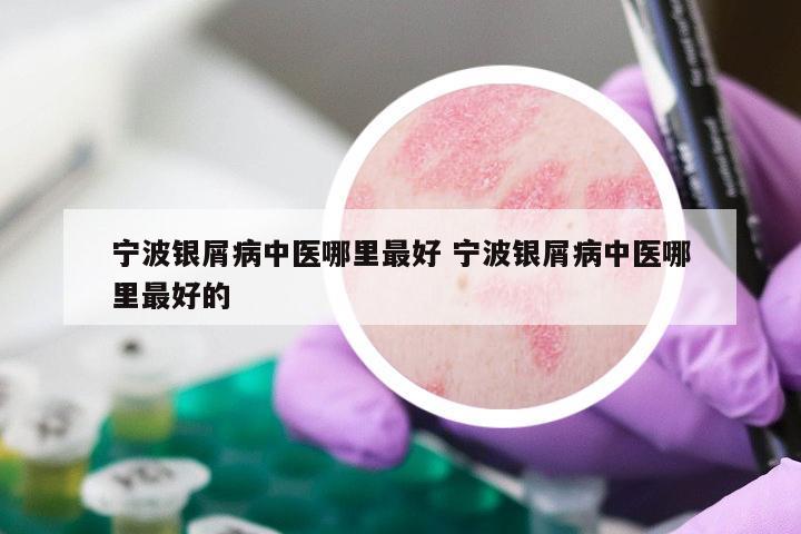 宁波银屑病中医哪里最好 宁波银屑病中医哪里最好的