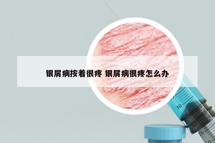 银屑病按着很疼 银屑病很疼怎么办
