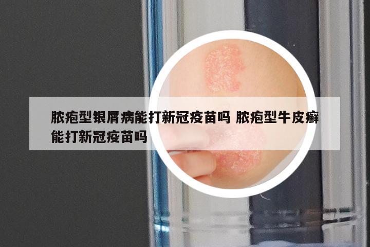 脓疱型银屑病能打新冠疫苗吗 脓疱型牛皮癣能打新冠疫苗吗