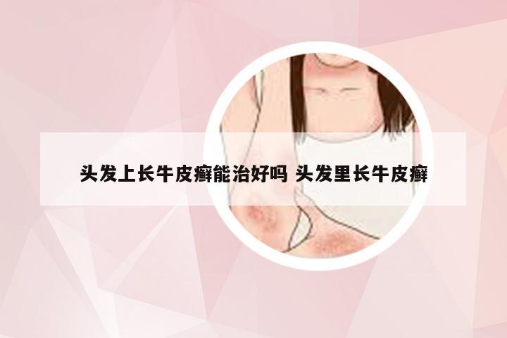 头发上长牛皮癣能治好吗 头发里长牛皮癣
