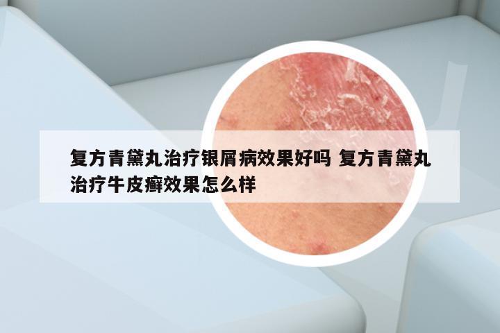 复方青黛丸治疗银屑病效果好吗 复方青黛丸治疗牛皮癣效果怎么样