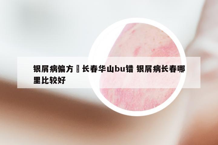 银屑病偏方來长春华山bu错 银屑病长春哪里比较好