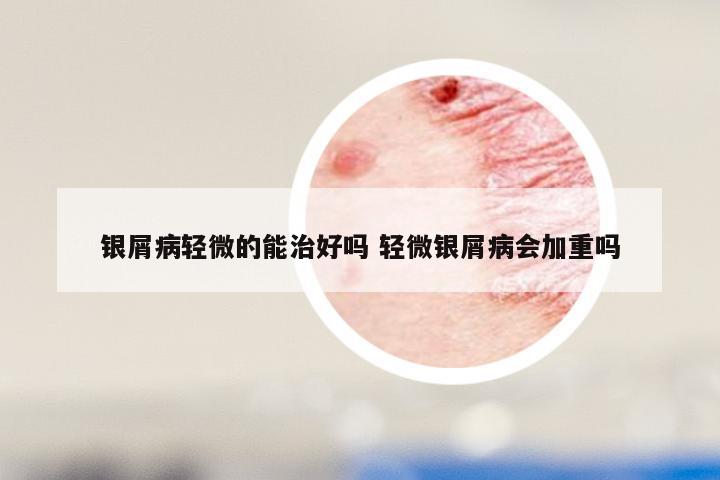 银屑病轻微的能治好吗 轻微银屑病会加重吗