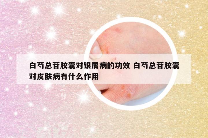 白芍总苷胶囊对银屑病的功效 白芍总苷胶囊对皮肤病有什么作用