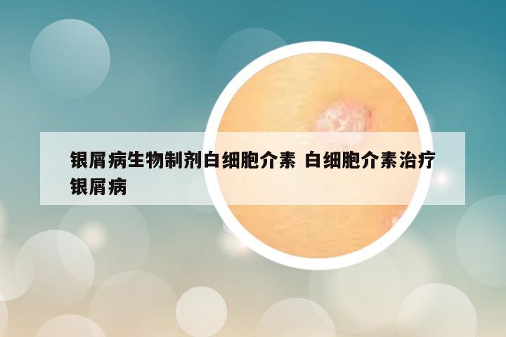 银屑病生物制剂白细胞介素 白细胞介素治疗银屑病