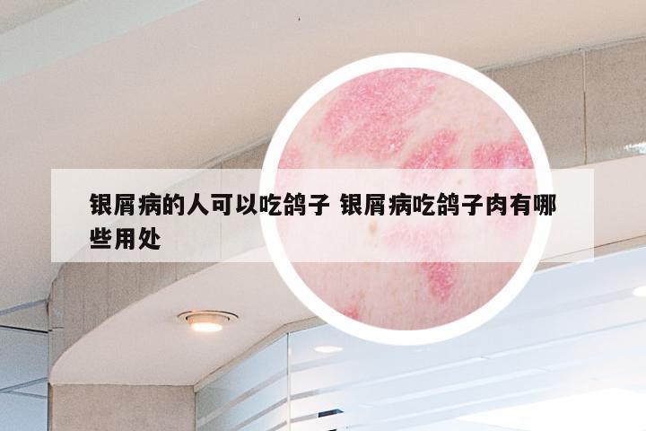 银屑病的人可以吃鸽子 银屑病吃鸽子肉有哪些用处