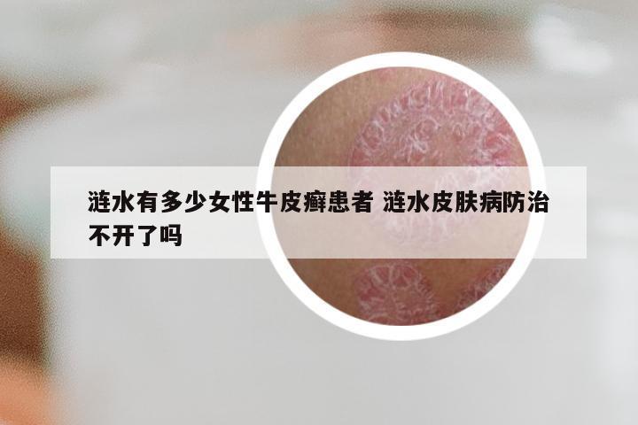 涟水有多少女性牛皮癣患者 涟水皮肤病防治不开了吗