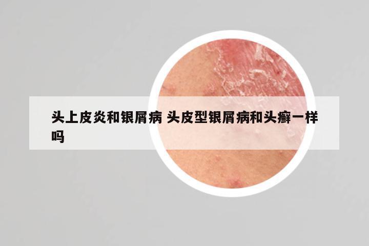 头上皮炎和银屑病 头皮型银屑病和头癣一样吗
