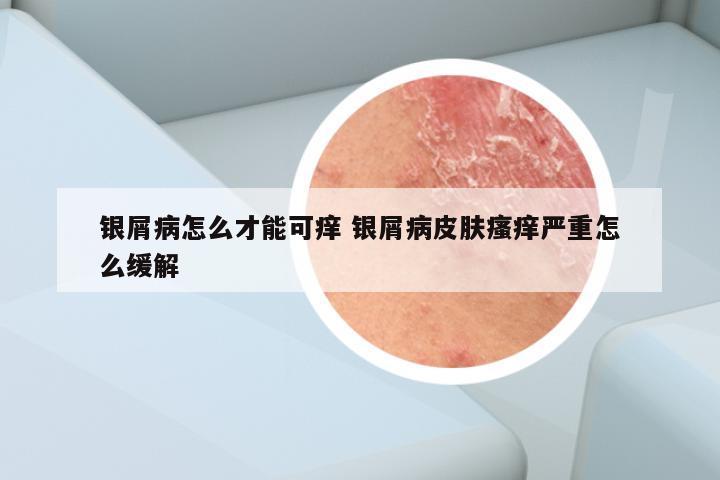 银屑病怎么才能可痒 银屑病皮肤瘙痒严重怎么缓解