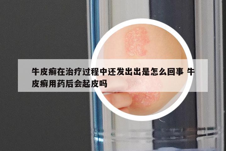 牛皮癣在治疗过程中还发出出是怎么回事 牛皮癣用药后会起皮吗