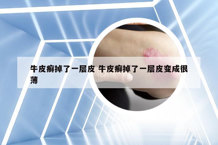 牛皮癣掉了一层皮 牛皮癣掉了一层皮变成很薄