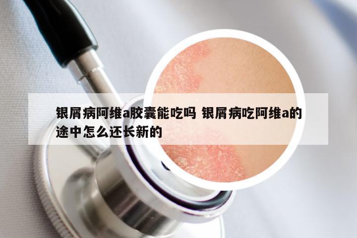银屑病阿维a胶囊能吃吗 银屑病吃阿维a的途中怎么还长新的