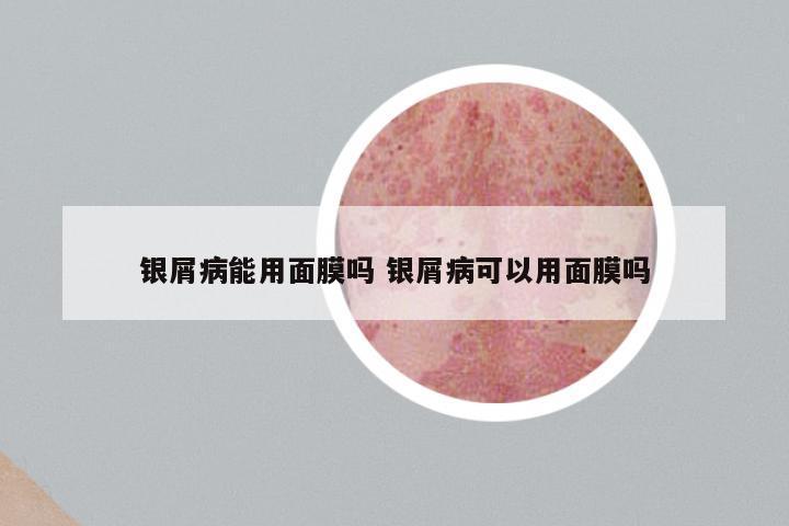 银屑病能用面膜吗 银屑病可以用面膜吗
