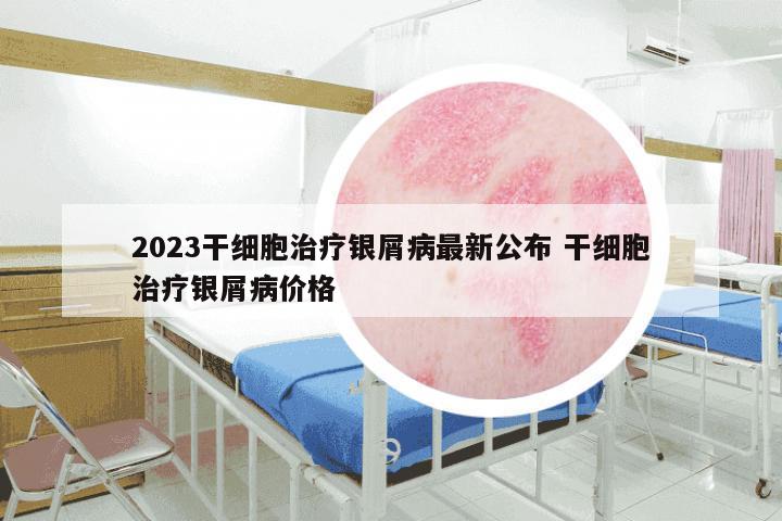 2023干细胞治疗银屑病最新公布 干细胞治疗银屑病价格