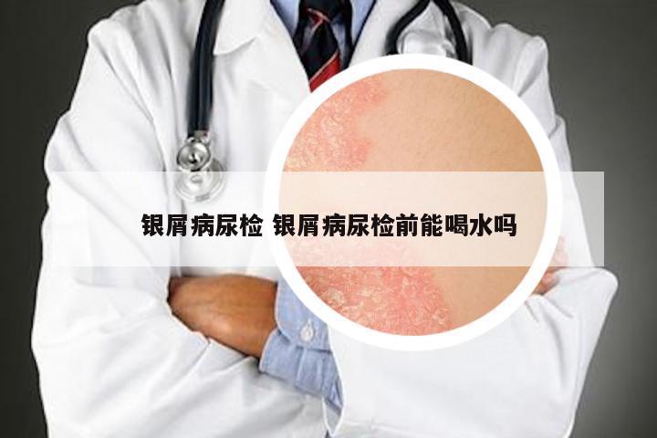 银屑病尿检 银屑病尿检前能喝水吗